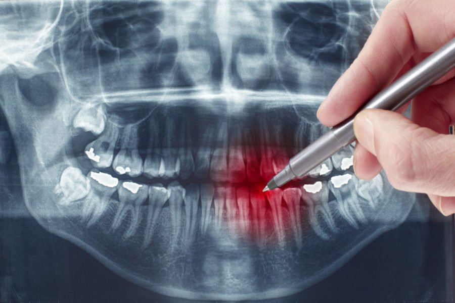 Is oral surgery covered under health insurance?